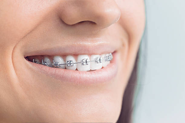 Dental Bonding in Bradley Beach, NJ